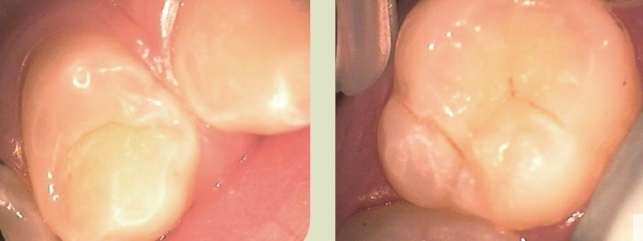 Abb. 1 u. 2: Links der gesunde Seitenzahn 14; rechts der zu behandelnde Zahn 16.