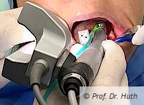 Denacam Handstück mit Kamera und Marker im Mund des Patienten (Bildvorlage Prof. Dr. Huth).