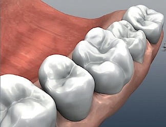 Abb. 1: Zahn 16, im vorliegenden Fall vorgesehen zur Präparation für ein Keramikinlay (mesial-okklusal-distal).