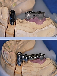 Abb. 1 u. 2: Umwandlung einer rein implantatgetragenen Kronenkonstruktion auf Implantaten 36 und 37 in eine implantatzahngetragene Verbundbrücke nach Verlust von Zahn 35 und Überkronungsbedürftigkeit von Zahn 34, verschraubt auf den Implantaten und mit Doppelkrone auf Zahn 34.