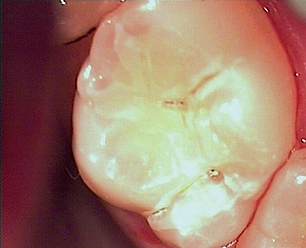 Abb. 3: Die Fissur von Zahn 16 wurde an zwei Stellen erweitert und mit Phosphorsäure angeätzt.