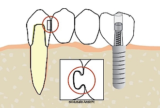 Abb. 3: Zahnintrusionsrisiko bei nicht rigider Geschiebekonstruktion durch fehlende Verschraubung.