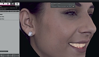Abb. 2: 3D-Darstellung des Patientengesichtes einschließlich zugeordneter 3D-Zahnmodelldaten.
