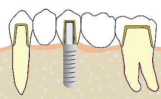 Abb. 4: Zahnintrusionsrisiko durch ungünstige Zahn-Implantat-Anordung mit Doppelkronen und provisorischer Zementierung [17].