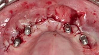 Abb. 4: Verschluss des Mukoperiostlappens nach Implantatinsertion.