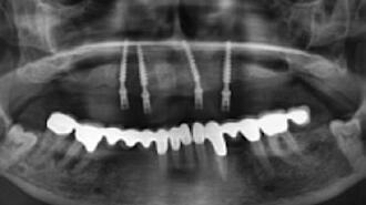 Abb. 5: Das postoperative Röntgenbild nach Entfernung der Zähne und Insertion der 4 Interimsimplantate.