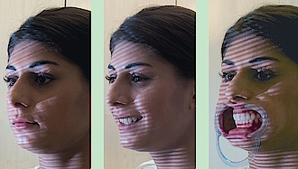 Abb. 7–9: Drei Aufnahmen werden benötigt: neutrales Gesicht, lachendes Gesicht, Aufnahme mit Wangenhalter.