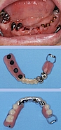 Abb. 7–9: Sofort-Hybridkombination mit Locatoren auf den Implantaten, Teleskopkronen auf 43, 44 und gegossener Klammer bzw. dentaler Auflage auf den endständigen Molaren.