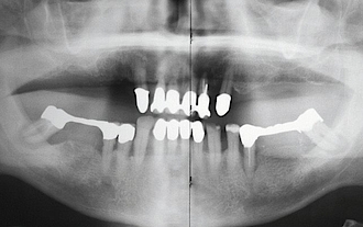 Abb. 10: Parodontal geschädigtes Gebiss vor der Versorgung. Die Zähne 12–22, 35, 37 und 47 sind nicht erhaltungsfähig.