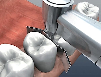 Abb. 7: Bei eingelegten Metallmatrizen wird anschließend die approximale Schmelzlamelle entfernt.