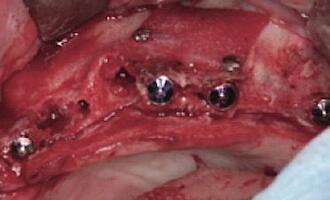 Abb. 10. Implantatinsertion und Sinuslift im Oberkiefer links.
