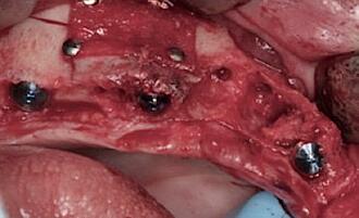 Abb. 11: Implantatinsertion und Sinuslift im Oberkiefer rechts.