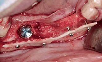 Abb. 12: Implantatinsertion im Unterkiefer rechts.
