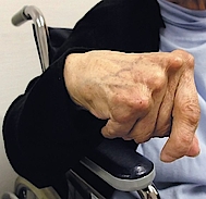 Abb. 9: Patientin mit rheumatoider Arthritis.