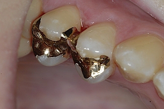 Abb. 12: ... die Inlays in den Zähnen 14 und 15 zementiert.