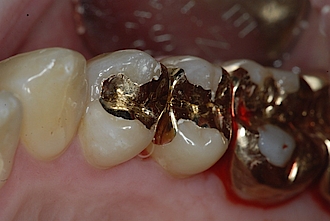 Abb. 13: Die zementierten Inlays in den Zähnen 24 und 25.