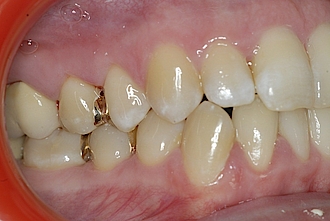 Abb. 14: Zähne 14 und 15 – Ansicht von bukkal.