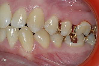 Abb. 15: Zähne 24 und 25 – Ansicht von bukkal.