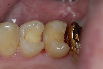 Abb. 2: Präparation der Zähne 24 und 25 mit Retentionsfräsungen.