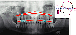 Abb. 3: Retroflexion (Orthophos – digitaler Röntgenatlas, Sirona Dental Systems GmbH, Bensheim).