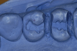 Abb. 4: Die präparierten Zähne 24 und 25 im Modell.
