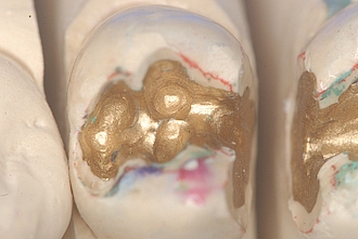 Abb. 7: Detailaufnahme von Zahn 14.