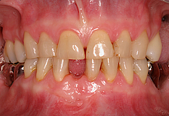 Abb. 2: Ausgangssituation mit fehlendem Zahn 41 und Zustand nach WSR sowie daraus resultierendem Knochendefekt (Fall 1).