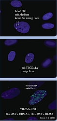 Abb. 3: Gamma-H2AX-Test zum Nachweis von Doppelstrangbrüchen in menschlichen Gingivafibroblasten nach Exposition gegenüber Methacrylaten. Jeder Lichtspot (Focus) repräsentiert einen stattgefundenen DNADoppelstrangbruch. Kontrolle mit Medium: wenig bis keine Foci. Exposition gegenüber TEGDMA: einige Foci. Exposition gegenüber BisGMA: viele Foci.