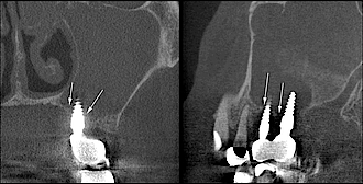 Abb. 8: Nachkontrolle nach einer ebenfalls andernorts erfolgten Implantation, nach der der Patient über sinusitische Beschwerden klagte. Die Kieferhöhle ist im DVT-Scan  ebenfalls deutlich komplett hyperdens gefüllt. Trotz der selbstverständlich auch hier zu erkennenden Aufhärtungsartefakte (Pfeile rechtes Bild), kann man sowohl im koronalen (links) als auch im sagittalen Schnitt (rechts) erahnen, dass das vertikale Knochenangebot um die Implantate sehr gering ist und deutlich unter fünf Millimetern liegt. Die klinisch vorliegende Mund-Antrum-Verbindung ist zu erahnen, kann jedoch aufgrund der Artefakte nicht mit absoluter Sicherheit auf den Aufnahmen verifiziert werden.