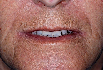 Abb. 11: Lippenbild der Patientin unmittelbar postoperativ mit den eingesetzten Provisorien im Ober- und Unterkiefer.