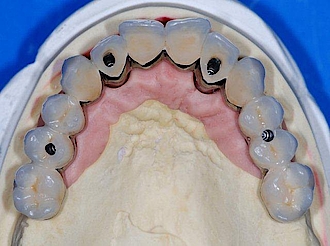 Abb. 13 a–d: Der fertige Zahnersatz vor der Eingliederung. Durch die präoperative digitale Implantationsplanung und die schablonengeführte Implantatinsertion konnte eine zur Zahnaufstellung ideale Implantatposition erreicht werden.