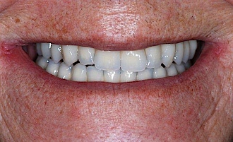 Abb. 16: Intraorale Situation der Patientin 4 Monate postoperativ mit dem eingesetzten definitiven Zahnersatz im Ober- und Unterkiefer.