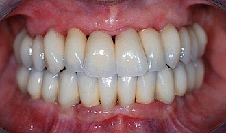 Abb. 17: Lippenbild der Patientin 4 Monate postoperativ mit dem eingesetzten definitiven Zahnersatz im Ober- und Unterkiefer.