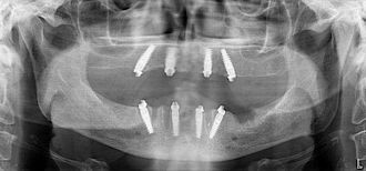 Abb. 8: Postoperatives OPG mit den eingebrachten Implantaten. Die distalständigen Implantate wurden anguliert, um im Oberkiefer den Sinus maxillaris und im Unterkiefer die Foramina mentalia zu passieren.