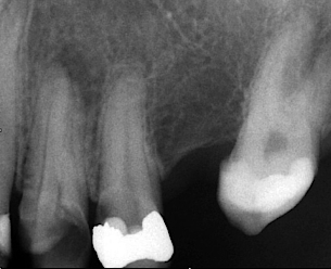 Abb. 4: Diagnostische Aufnahme Zahn 24.
