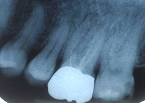 Abb. 1: Der Zahnfilm zeigt eine apikale Aufhellung bei inkompletter Wurzelfüllung (5/2010).