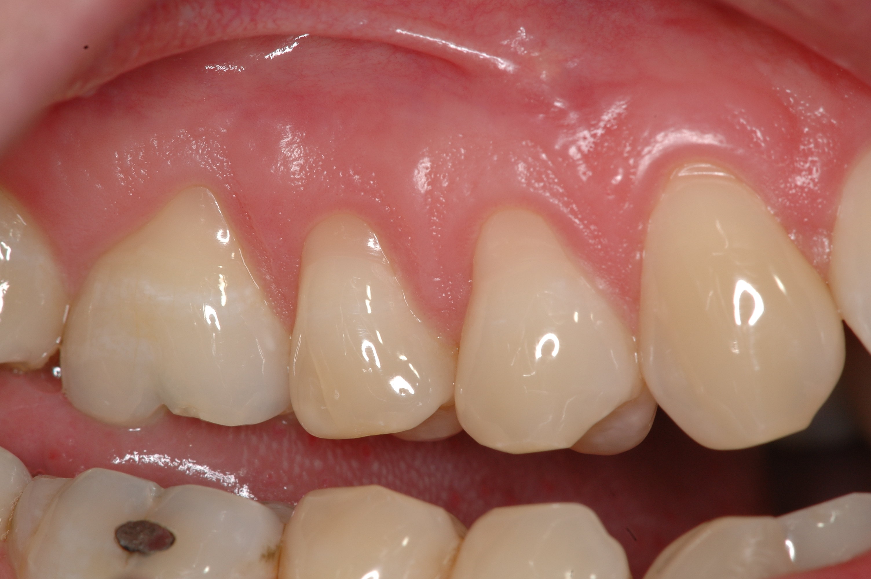 Der schmerzempfindliche Zahn - lästige Überempfindlichkeit oder manifeste E...